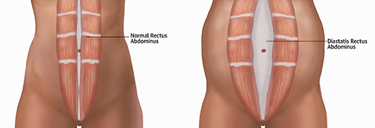 A picture of the back side of a person 's abdomen.