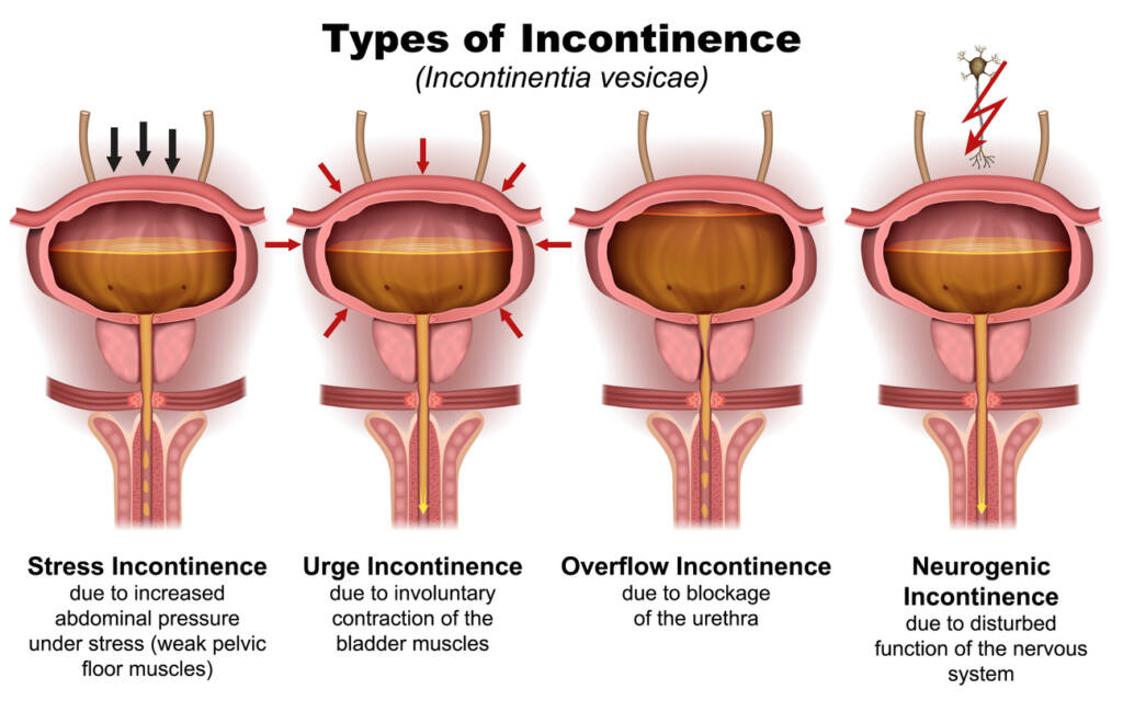 A picture of different types of incontinence.